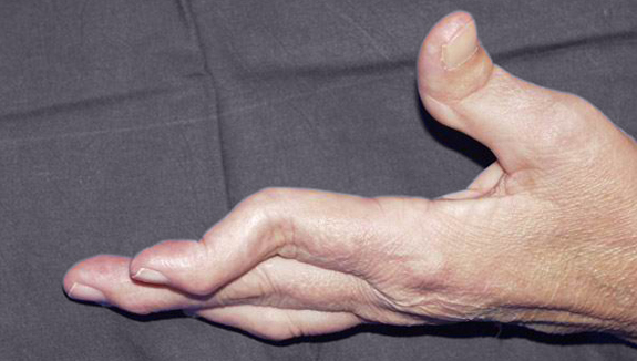 Swan-neck deformity